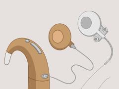 Implantierte Hörgeräte bei Kindern und