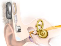 Knochenverankerte Hörgeräte von Oticon Medical