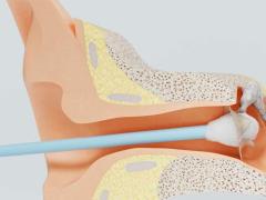 Loch im Trommelfell: Behandlung, Ursachen