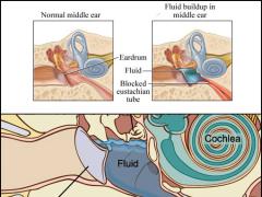 Paukenerguss: Behandlung, Ursachen, Symptome und
