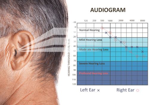 Audiogramm
