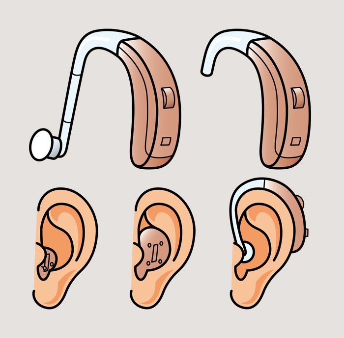 Hörgeräte Typen und Arten