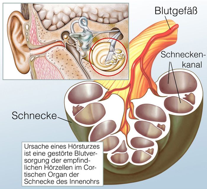 Hörsturz Illustration