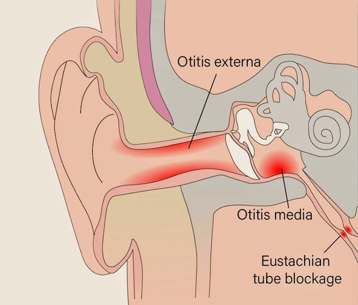 Mittelohrentzündungen