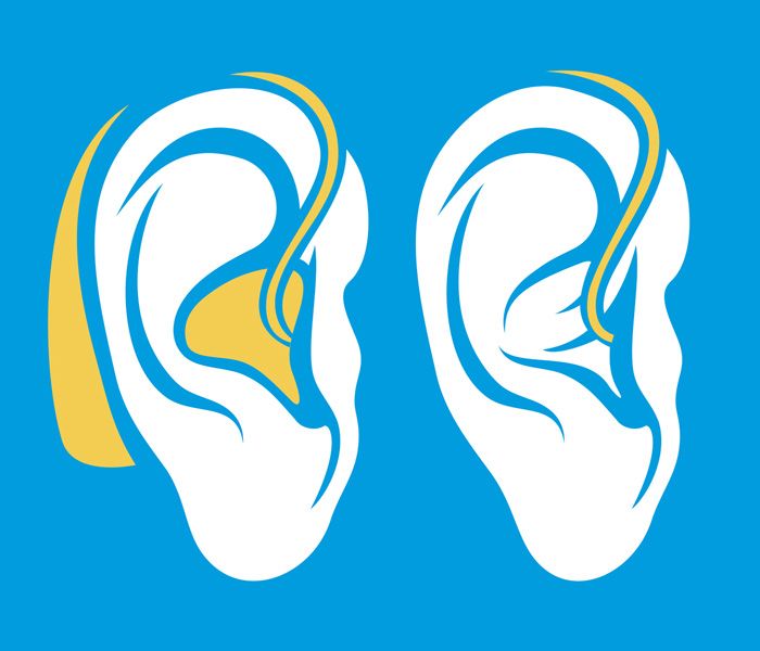 Tieftonschwerhörigkgeit