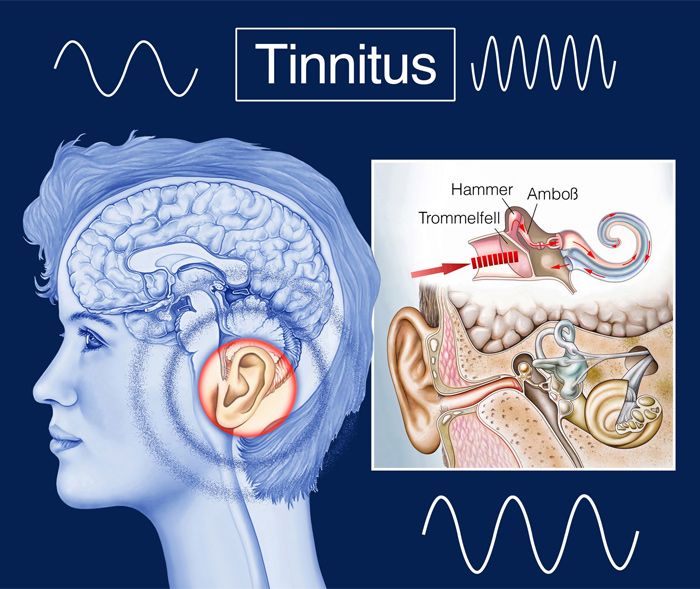 Tinnitus Grafik