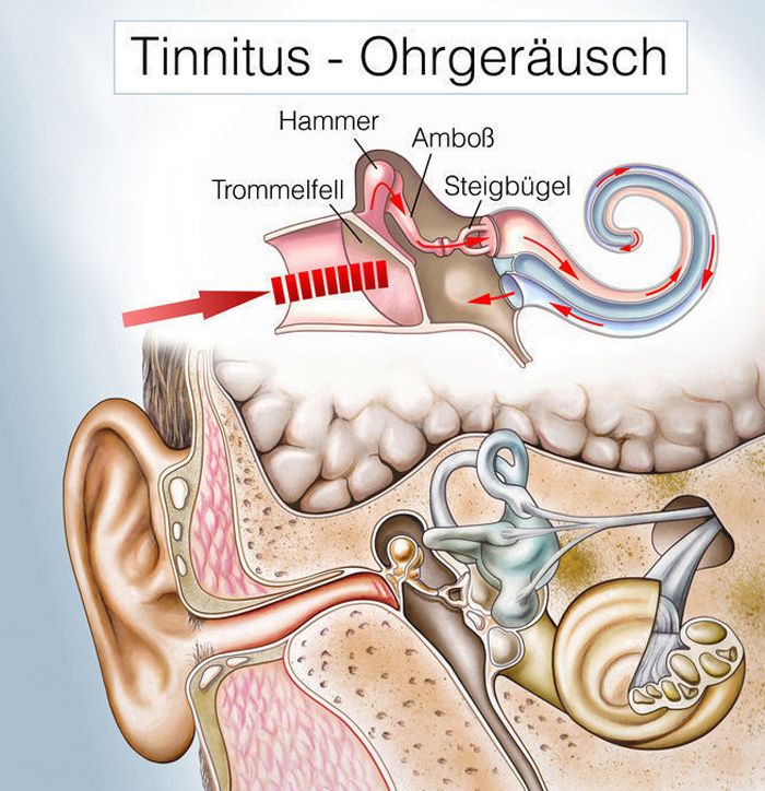 Tinnitus Ohrgeräusch Grafik
