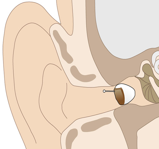 siemens hoergeraete imini